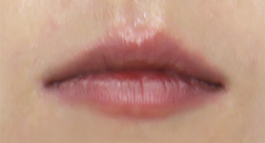 Filler – Under-eye / Anterior Cheekbone