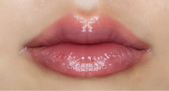 Filler – Cheek / Mid-face