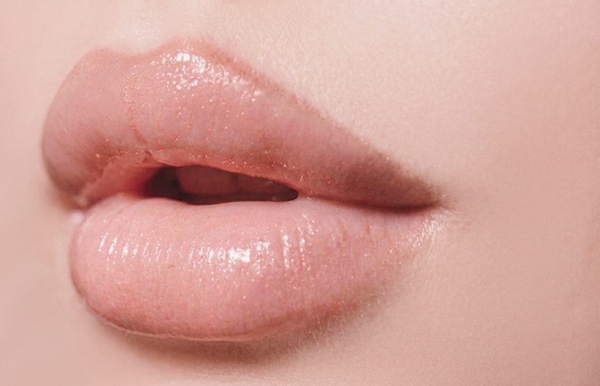 Lip Filler (Signature Lip)