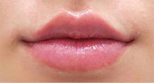 Filler – Forehead / Temple